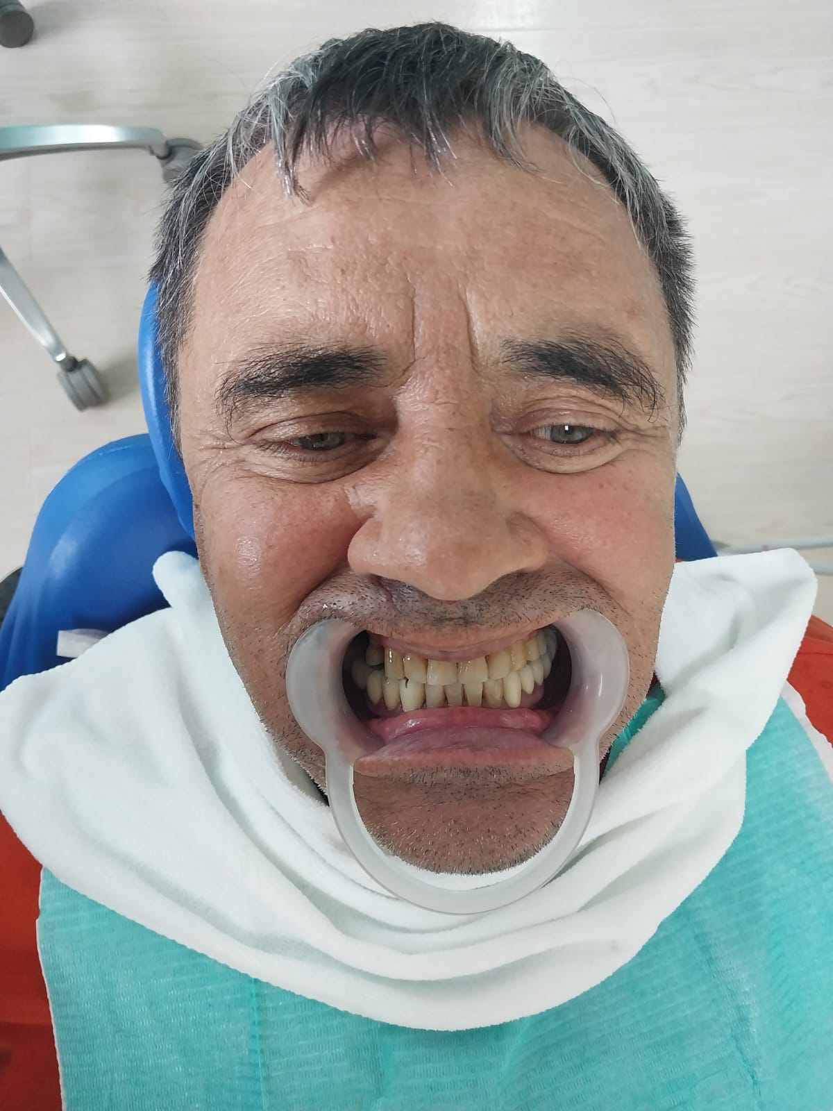 до протезировании зубов в Китае